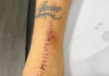 A cicatriz da luta! Lyanco posta forte imagem da cirurgia no tendão – Galo 360 Oficial