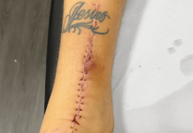 A cicatriz da luta! Lyanco posta forte imagem da cirurgia no tendão – Galo 360 Oficial