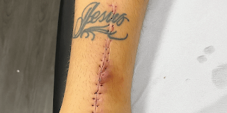 A cicatriz da luta! Lyanco posta forte imagem da cirurgia no tendão – Galo 360 Oficial