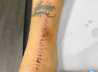 A cicatriz da luta! Lyanco posta forte imagem da cirurgia no tendão – Galo 360 Oficial